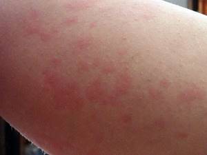 Контактная аллергия у детей проявления