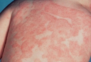 Аллергия красные пятна чешутся