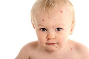 Против аллергии детям