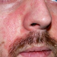 Аллергия на коже тела