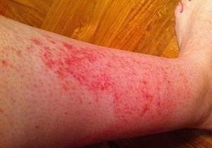 Аллергия на ногах сыпь