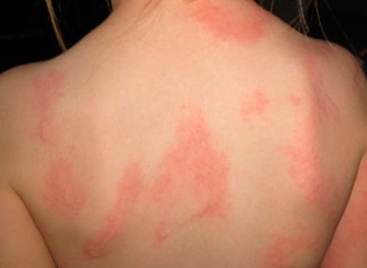 Аллергия крапивница что делать