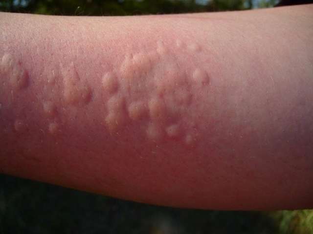 Аллергия на комаров