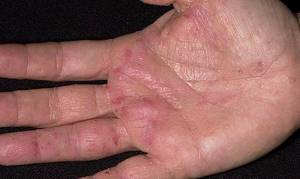 Кожный дерматит на руках