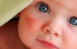 Лечение аллергии у детей комаровский