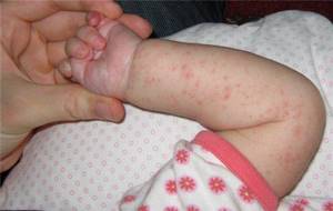 У ребенка не проходит аллергия