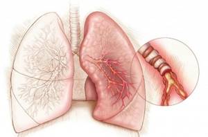 Первая помощь при бронхиальной астме