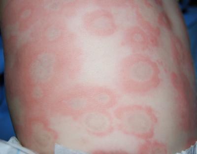 Аллергия красные пятна чешутся