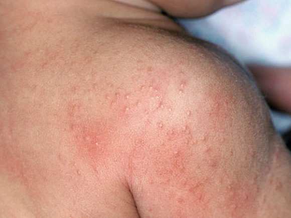 Как проявляется аллергия на лактозу у грудничков