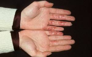 Экзема на пальцах рук лечение