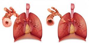 Неотложная помощь при бронхиальной астме алгоритм действий
