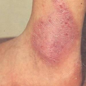 Инфекционный дерматит на ногах