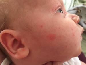 Что делать если у новорожденного аллергия