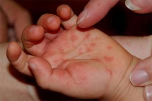 Аллергия на ладошках у ребенка