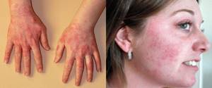 Аллергия на лаванду симптомы