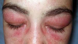 Аллергия на коже вокруг глаз