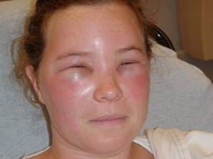 Аллергия на креветки симптомы