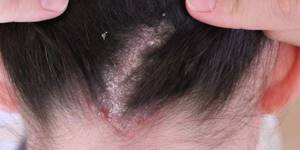 Себорейный дерматит кожи головы лечение