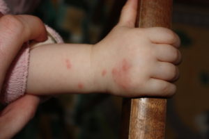 Контактный дерматит у детей