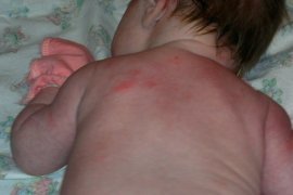 Аллергия на подсолнечное масло у грудничка