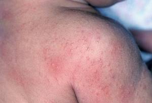Аллергия на рис у грудничка