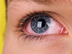 Аллергия глаза чешутся что делать