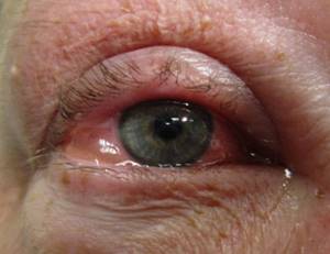 Как снять отек с глаза при аллергии