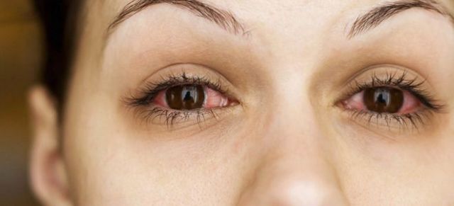 Глазные капли при аллергии