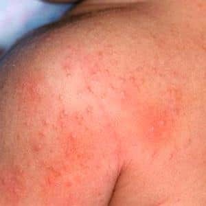 Аллергический дерматит у детей симптомы