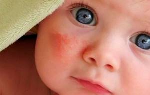 Капли от аллергии для детей фенистил