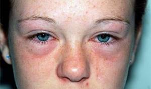 Опухло лицо от аллергии что делать