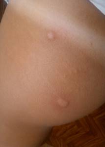 Аллергия похожая на укусы комаров
