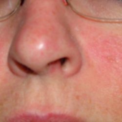 Аллергические проявления на коже