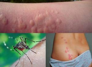 Аллергия как укусы насекомых