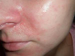 Аллергия на хлорку в бассейне у ребенка