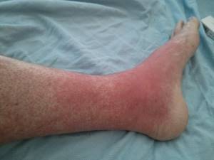 Аллергия на ногах