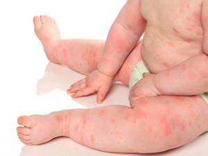 Аллергия у младенца на смесь
