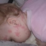 Аллергия на нурофен