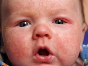Как выглядит аллергия у детей