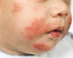 Может ли быть аллергия на гипоаллергенную смесь