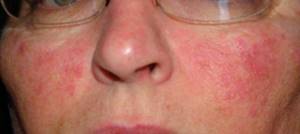 Аллергия на коже сыпь