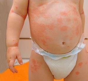 Аллергия у ребенка красные пятна на ногах