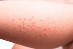 Какие паразиты вызывают аллергию