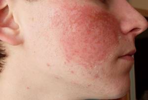 Как убрать аллергию с лица