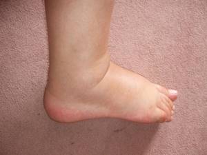 Аллергический отек ног
