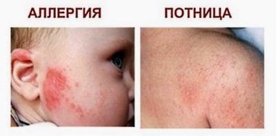 Потница или аллергия у новорожденных как отличить