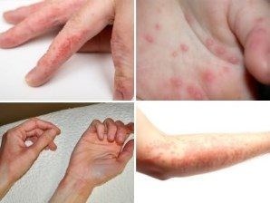 Аллергия на пальцах