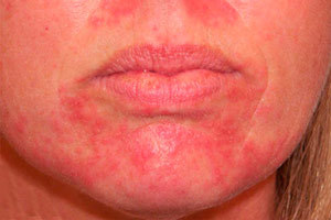 Лечение перорального дерматита на лице