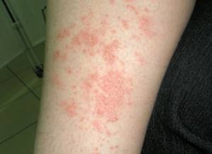Первая помощь при аллергии на коже