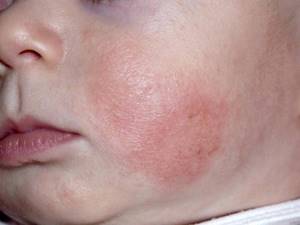 Аллергия на коже у грудного ребенка